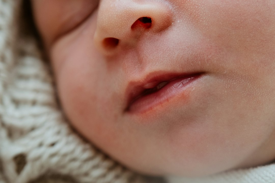 sarpullido bebe dientes - La irritación suele aparecer alrededor de la boca y la barbilla.